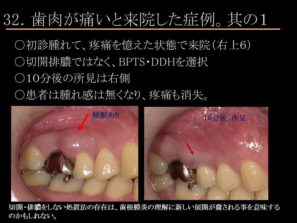 歯根膜炎で歯肉が腫れる｜こすが歯科医院